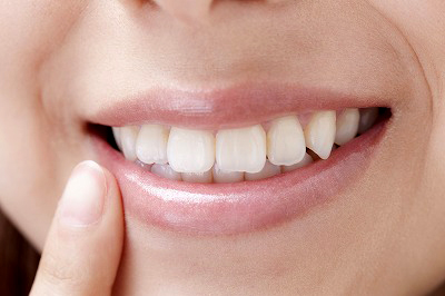 セレックシステムを導入したセラミック治療